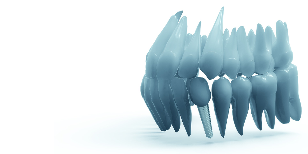implant uygulaması
